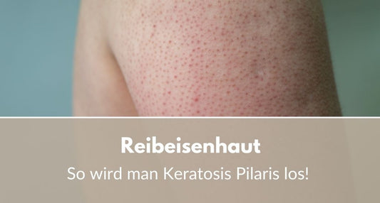 Reibeisenhaut: So wird man Keratosis Pilaris los!